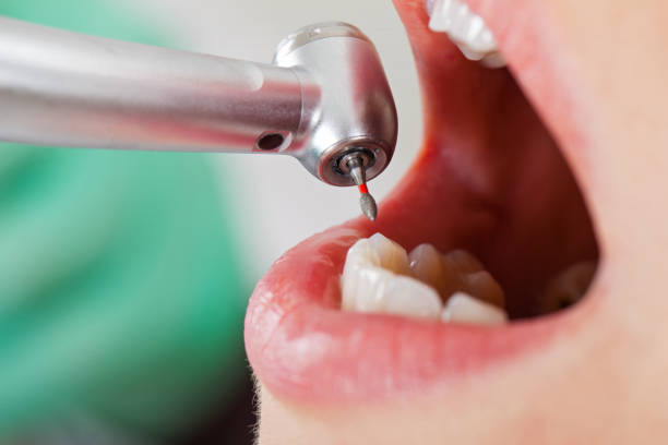 Best Emergency Dental Care for Broken or Chipped Teeth in Choctaw Lake, OH